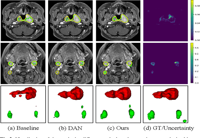 Figure 3 for Semi-supervised Segmentation via Uncertainty Rectified Pyramid Consistency and Its Application to Gross Target Volume of Nasopharyngeal Carcinoma