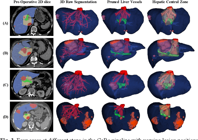 Figure 4 for CoRe: An Automated Pipeline for The Prediction of Liver Resection Complexity from Preoperative CT Scans