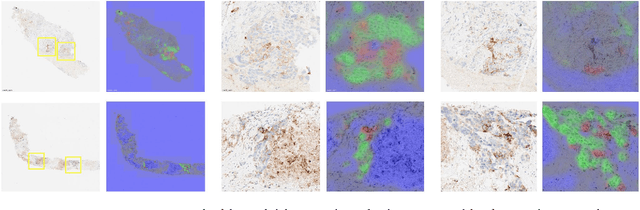 Figure 3 for Deep Semi Supervised Generative Learning for Automated PD-L1 Tumor Cell Scoring on NSCLC Tissue Needle Biopsies