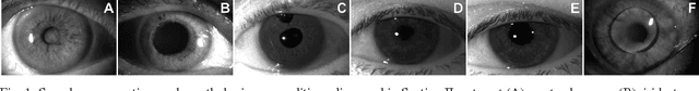 Figure 1 for Database of iris images acquired in the presence of ocular pathologies and assessment of iris recognition reliability for disease-affected eyes