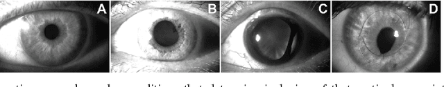Figure 2 for Database of iris images acquired in the presence of ocular pathologies and assessment of iris recognition reliability for disease-affected eyes