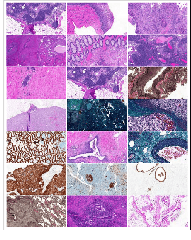Figure 1 for Learning with less data via Weakly Labeled Patch Classification in Digital Pathology
