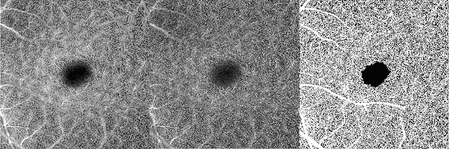 Figure 3 for Microvasculature Segmentation and Inter-capillary Area Quantification of the Deep Vascular Complex using Transfer Learning