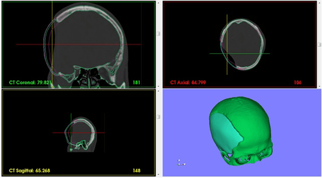 Figure 1 for Computer-aided implant design for the restoration of cranial defects