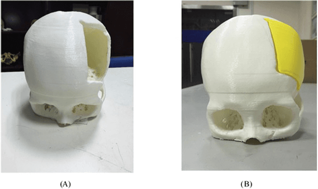 Figure 2 for Computer-aided implant design for the restoration of cranial defects