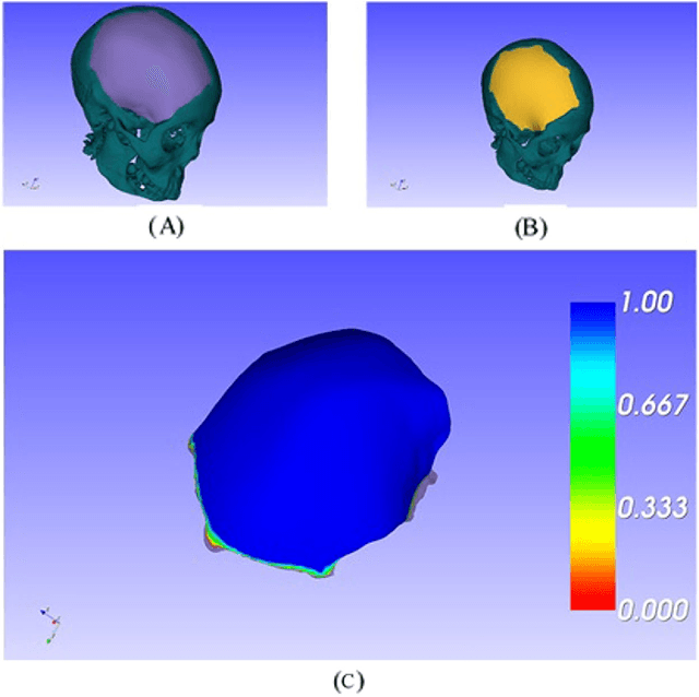 Figure 3 for Computer-aided implant design for the restoration of cranial defects