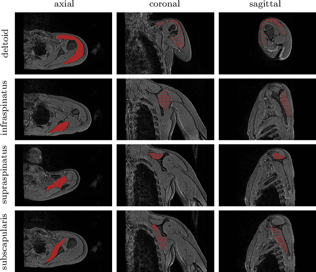 Figure 1 for Healthy versus pathological learning transferability in shoulder muscle MRI segmentation using deep convolutional encoder-decoders