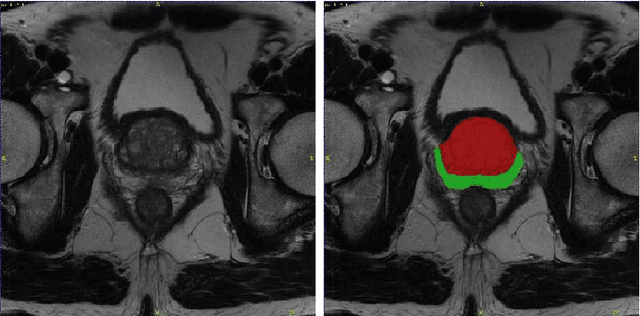 Figure 1 for Autoencoders for Multi-Label Prostate MR Segmentation