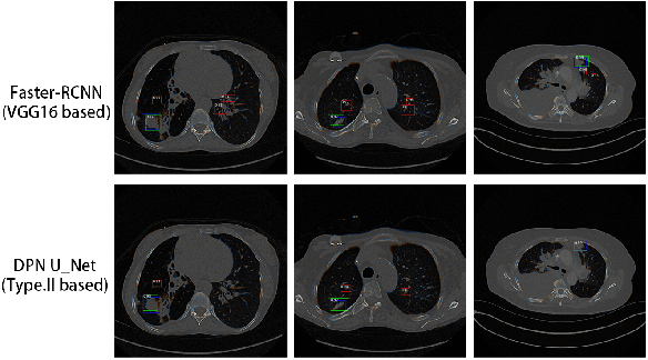 Figure 3 for Dual Skip Connections Minimize the False Positive Rate of Lung Nodule Detection in CT images