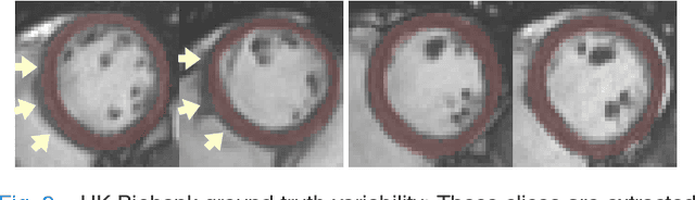 Figure 3 for 3D Consistent & Robust Segmentation of Cardiac Images by Deep Learning with Spatial Propagation