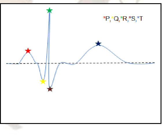 Figure 1 for Wavelet Based QRS Complex Detection of ECG Signal
