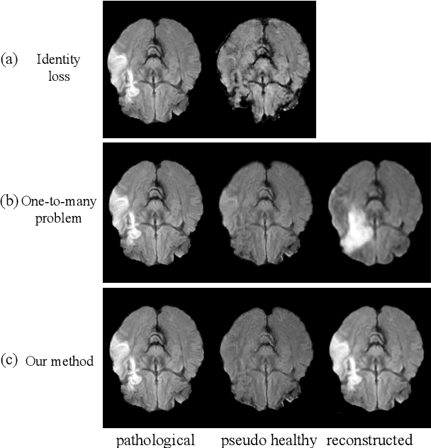 Figure 1 for Pseudo-healthy synthesis with pathology disentanglement and adversarial learning