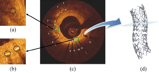 Figure 1 for Deep Local Global Refinement Network for Stent Analysis in IVOCT Images