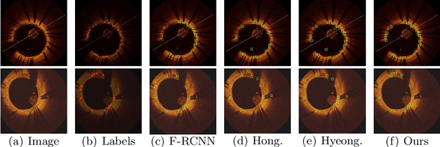 Figure 4 for Deep Local Global Refinement Network for Stent Analysis in IVOCT Images