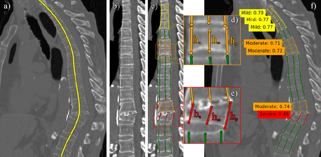 Figure 1 for Keypoints Localization for Joint Vertebra Detection and Fracture Severity Quantification