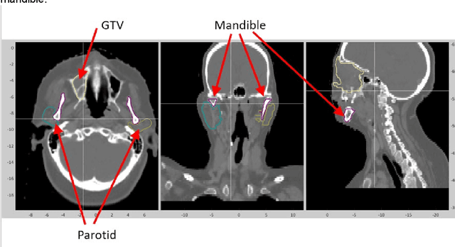 Figure 2 for Classification of anatomic structures in head and neck by CT-based radiomics