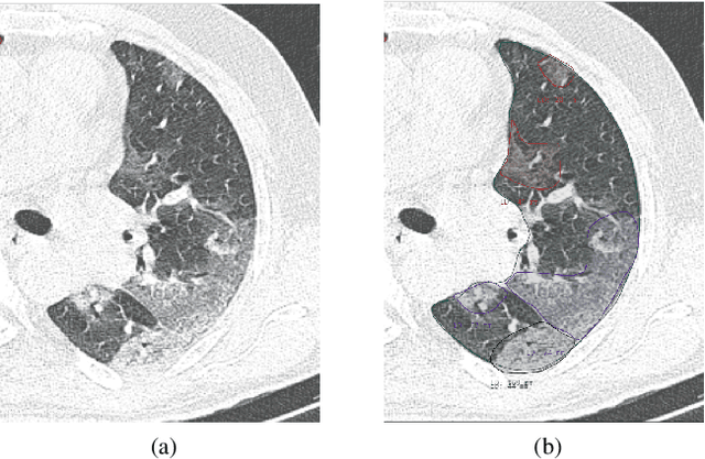 Figure 1 for Segmentation of Pulmonary Opacification in Chest CT Scans of COVID-19 Patients