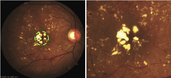 Figure 2 for An Efficient Framework for Automated Screening of Clinically Significant Macular Edema
