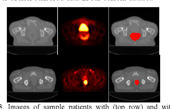 Figure 4 for Deep Convolutional Neural Networks for Imaging Data Based Survival Analysis of Rectal Cancer