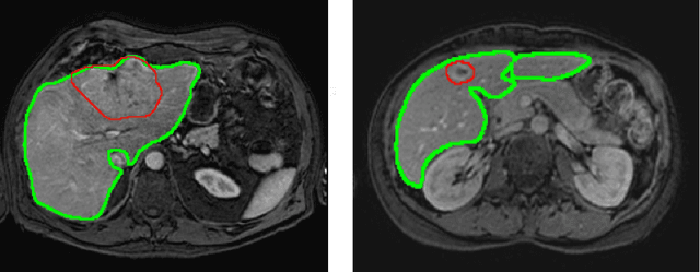 Figure 1 for Optimal input configuration of dynamic contrast enhanced MRI in convolutional neural networks for liver segmentation