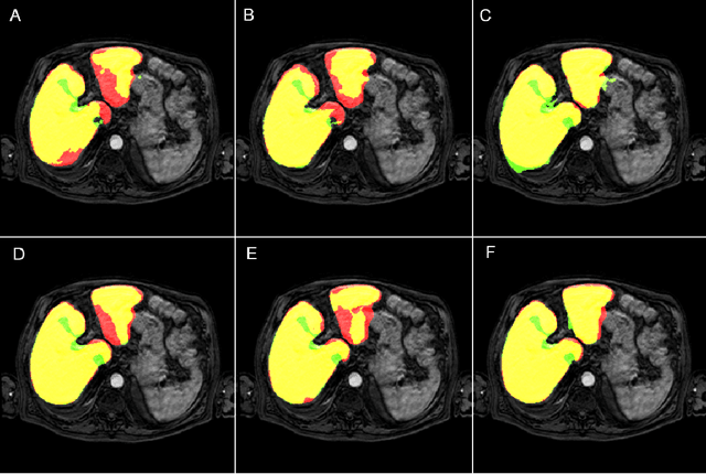 Figure 4 for Optimal input configuration of dynamic contrast enhanced MRI in convolutional neural networks for liver segmentation