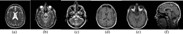 Figure 1 for A Review on Automated Brain Tumor Detection and Segmentation from MRI of Brain