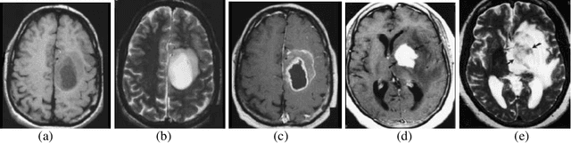 Figure 2 for A Review on Automated Brain Tumor Detection and Segmentation from MRI of Brain