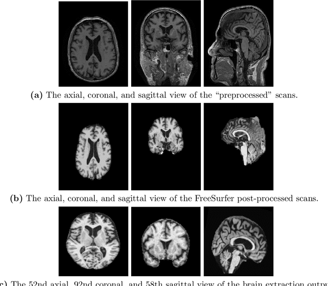 Figure 3 for A Comprehensive Study of Alzheimer's Disease Classification Using Convolutional Neural Networks