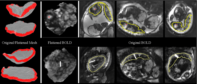 Figure 4 for Placental Flattening via Volumetric Parameterization