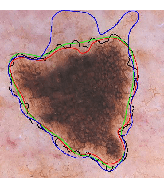Figure 1 for An Improved Objective Evaluation Measure for Border Detection in Dermoscopy Images