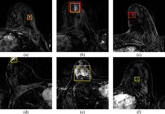 Figure 4 for Automatic Breast Lesion Detection in Ultrafast DCE-MRI Using Deep Learning