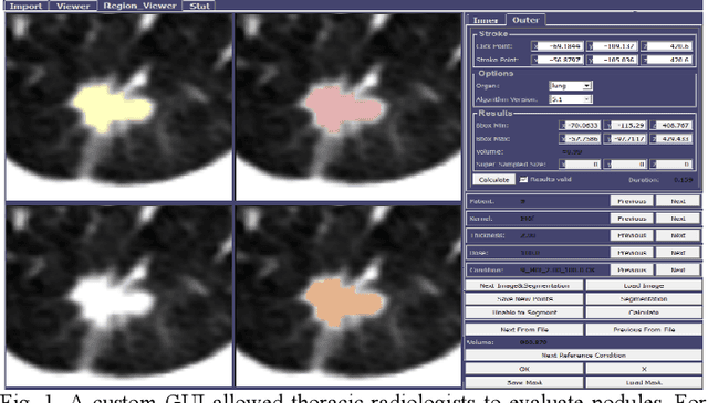 Figure 1 for Are Quantitative Features of Lung Nodules Reproducible at Different CT Acquisition and Reconstruction Parameters?