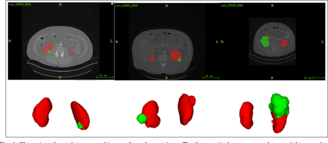 Figure 1 for Multi-Scale Supervised 3D U-Net for Kidneys and Kidney Tumor Segmentation
