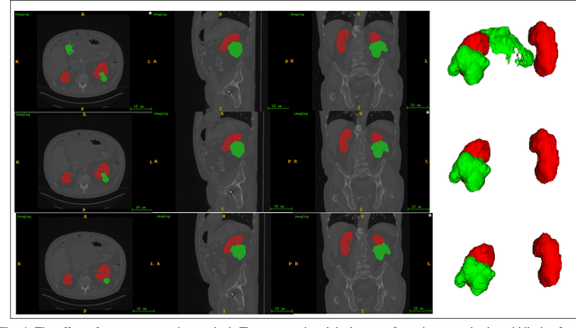 Figure 4 for Multi-Scale Supervised 3D U-Net for Kidneys and Kidney Tumor Segmentation