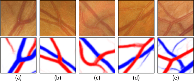 Figure 1 for Grading the Severity of Arteriolosclerosis from Retinal Arterio-venous Crossing Patterns