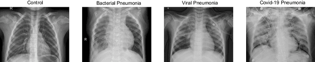 Figure 2 for Tiled sparse coding in eigenspaces for the COVID-19 diagnosis in chest X-ray images