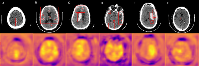 Figure 2 for Weakly supervised deep learning-based intracranial hemorrhage localization