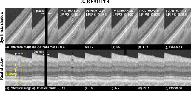 Figure 3 for Multi-scale Sparse Representation-Based Shadow Inpainting for Retinal OCT Images