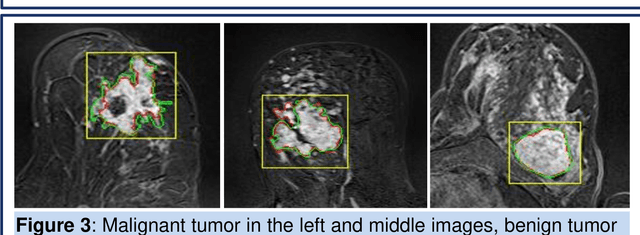 Figure 3 for Semi-Automatic Algorithm for Breast MRI Lesion Segmentation Using Marker-Controlled Watershed Transformation