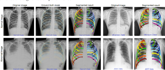 Figure 2 for VinDr-RibCXR: A Benchmark Dataset for Automatic Segmentation and Labeling of Individual Ribs on Chest X-rays