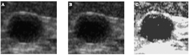 Figure 2 for Weighted Contourlet Parametric (WCP) Feature Based Breast Tumor Classification from B-Mode Ultrasound Image