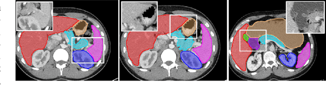 Figure 1 for Recurrent Feature Propagation and Edge Skip-Connections for Automatic Abdominal Organ Segmentation