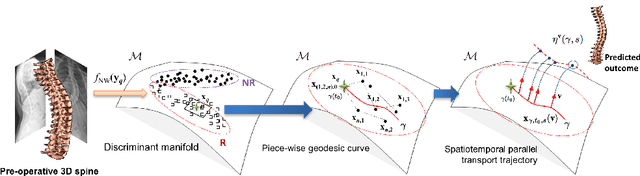 Figure 1 for Spatiotemporal Manifold Prediction Model for Anterior Vertebral Body Growth Modulation Surgery in Idiopathic Scoliosis