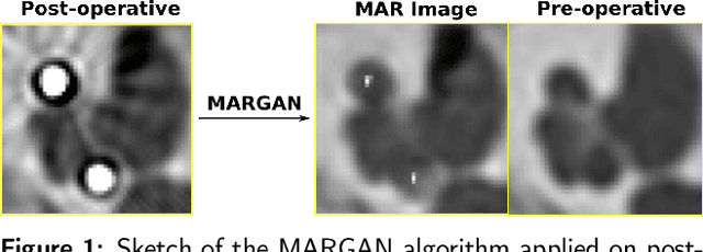 Figure 1 for Inner-ear Augmented Metal Artifact Reduction with Simulation-based 3D Generative Adversarial Networks
