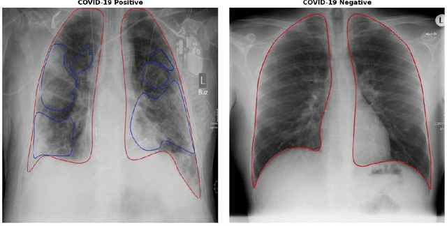 Figure 1 for Improving COVID-19 CXR Detection with Synthetic Data Augmentation