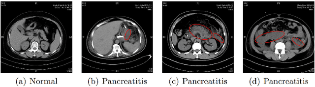 Figure 1 for Region-Manipulated Fusion Networks for Pancreatitis Recognition