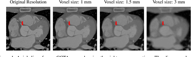 Figure 3 for CNN-based Landmark Detection in Cardiac CTA Scans