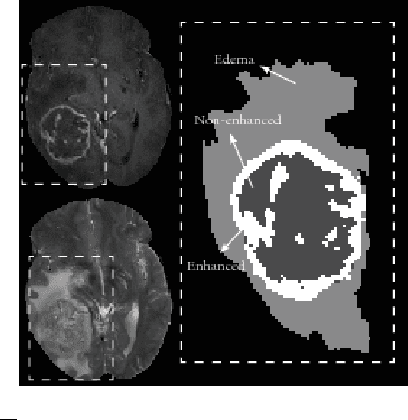 Figure 1 for Within-Brain Classification for Brain Tumor Segmentation