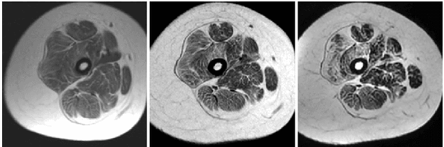 Figure 1 for Severity classification in cases of Collagen VI-related myopathy with Convolutional Neural Networks and handcrafted texture features