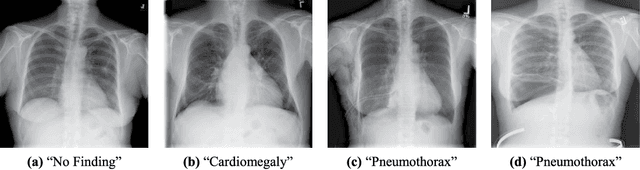 Figure 1 for Comparison of Deep Learning Approaches for Multi-Label Chest X-Ray Classification